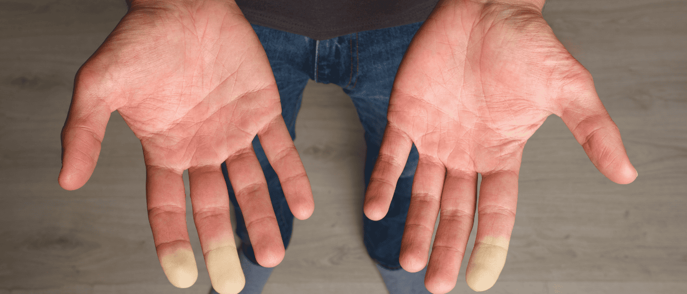 raynauds