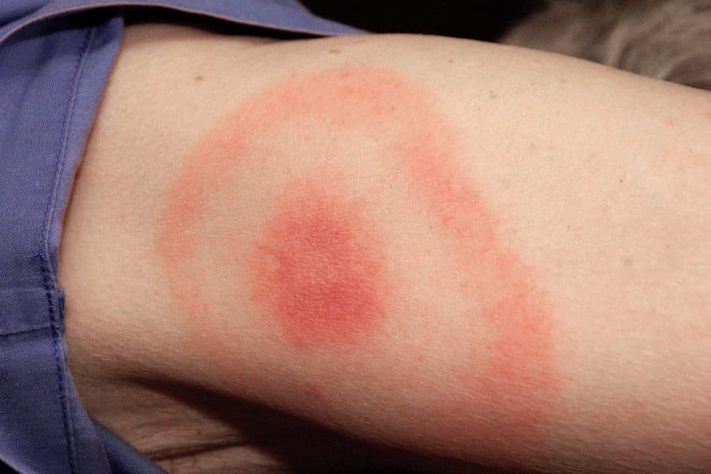 S_0817_lyme-disease_C0031417.width-1534